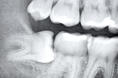 Rimozione Denti del Giudizio